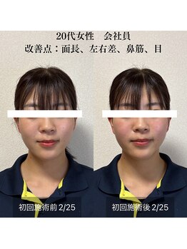 ザ リフト カドモリ 鹿児島 霧島(The Lift KADOMORI)/20代女性/面長、左右差、鼻、目