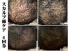 《４回券》【育毛促進技術】スカルプ棘ケア(1g)×ドライヘッド　※期限３ヶ月