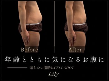 ビューティーサロン リリー(Lily)の写真/最新痩身マシン『CELL SHOT』導入◎年齢を言い訳にしない。理想のボディラインを今こそ叶える☆