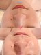 エテル(eter)の写真/【40代からのたるみ毛穴対策】しぼんだ年齢肌にハリ復活◆水光ピールで毛穴を引き締め滑らかな透明感へ