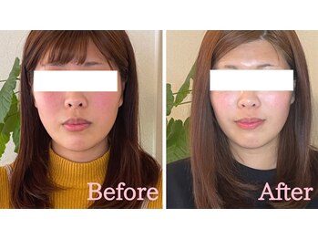 小顔矯正サロン ブルーム/施術3回ビフォーアフター