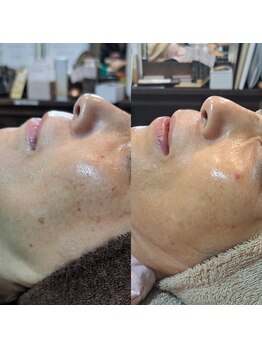 アースコアフュールボーテ ひたち野うしく店(EARTH coiffure beaute)/シミ照射2回の結果☆