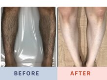 ル ココン(le cocon)の雰囲気（メンズ足脱毛★before→after★数回で効果実感◎）