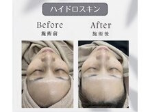 アイソワン (ai soin)/ハイドロスキン～Before/After