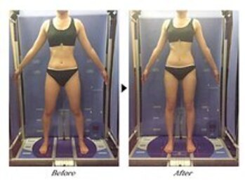 ビューティークリニックコダマ 日向店/【1か月コース】M.S様(25歳)