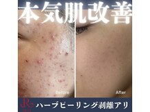 エヴァーグレース 三河安城店(EVER GRACE)/ハーブピーリング