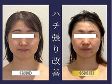 エレミュー 烏丸(Elemue.)/《30代》頭のハチ張り改善