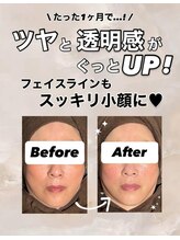 ビレボ マエバシ(BEREVO maebashi)/Before After