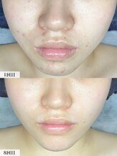 アンドミー 中百舌鳥(&me) ララピール ピーリング