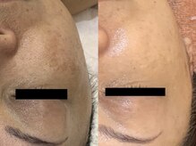 パルファンカルム 駅西本町店/剥けないハーブピーリング！