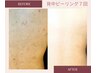 【背中ケア】背中のニキビちゃんに!剥離ありハーブピーリング