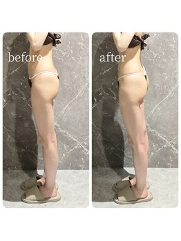 インディバ 六本木/【下半身痩身】before→after