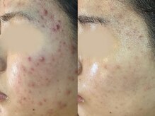 エヌエースキン 北谷店(NAskin)/ハーブピーリング｜ニキビケア