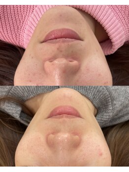 ベルファーム(Belle Femme)/肌荒れケアしましょう!