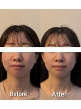 ノア(NOA)/ビフォーアフター