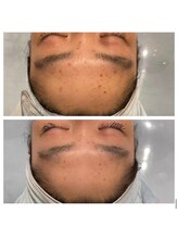 ココンフワット(Coconfouato)/毛穴レスアクアダーマ 肌質改善