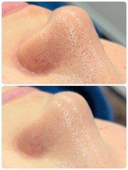 エン(en.)/韓国式3d毛穴洗浄