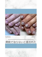 ティアラネイル 宇都宮/深爪矯正