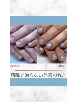 ティアラネイル 宇都宮/深爪矯正