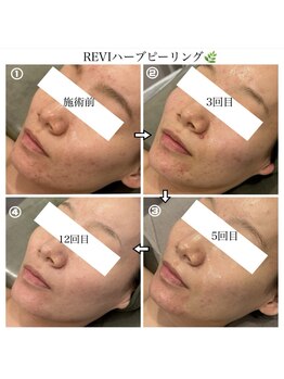 クラン 森ノ宮店(Clan)/ホームケア+ハーブピーリング