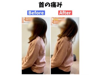 美波整体院 本宮院/首の痛み(Before After)