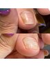 フット巻き爪ケア＊チップ付替え【ネイルトリムnailtrim】ケア込