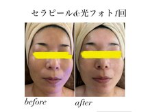 マスカレード(Masquerade)の雰囲気（セラピール＋光フォト1回）