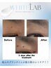 【次世代!】ホワイトラボ★最新シミケア【顔一カ所2センチ×2センチ】