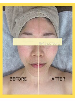 アルゴ 高崎店(ALGO)/ 小顔脱毛