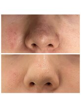 トリコ(torico*)/毛穴黒ずみ編＊before　after＊