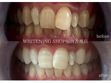 ホワイトニングショップ 福岡香椎店/美容ホワイトニングbefore after