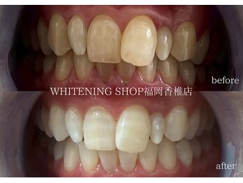 ホワイトニングショップ 福岡香椎店/美容ホワイトニングbefore after