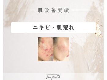 スリースリー 恵比寿(THREE THREE)/ニキビ・肌荒れケア改善実績写真