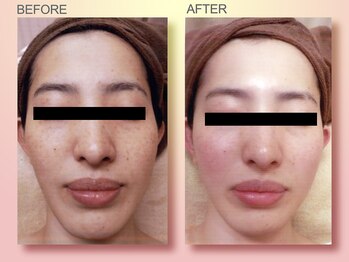 ジュリア オージェ 京橋店/ビフォーアフター(シミケアP)