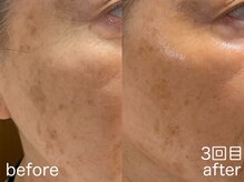 ハレオラ(HaleOla)/70代　素肌を育てる1stSTEP3回目