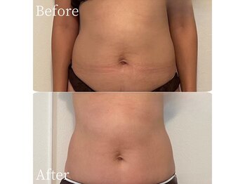 ミスティア(mistia)/エステ お腹4回