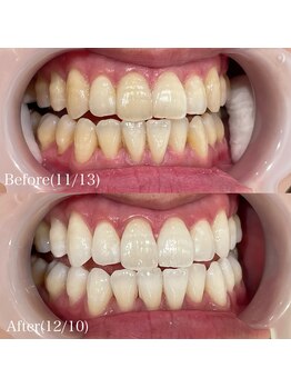 ホワイトニングカフェ 吉祥寺店(WhiteningCafe)/プレミアムホワイトニング