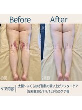 スー(Sue)/ふくらはぎ～腿アフターケア