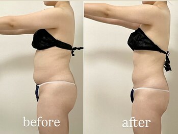 ラヴィアンローズ 忠節店(La vie en Rose)/ウルトラ筋膜 before→after