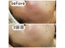 【剥離なしハーブピーリング】くすみ、シミ、ニキビ、小じわに！