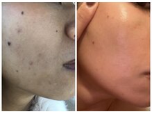 サリーエミリー 北千住店(SallyEmiry)/ハーブと白玉肌管理の最強コース