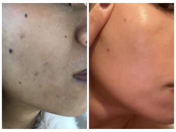 サリーエミリー 北千住店(SallyEmiry)/ハーブと白玉肌管理の最強コース