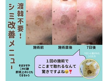 ザ ベッピン(the 別嬪)/渡韓不要！シミケア