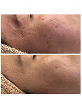 トリコ(torico*)/肌の凹凸改善＊before　after＊