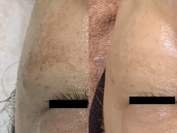 パルファンカルム 駅西本町店/待望!日帰りハーブピーリング