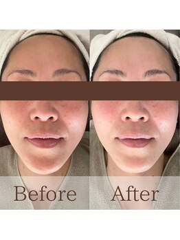 凪眠の写真/気になり始めた口横のぽにょ、フェイスラインのたるみをしっかり解決☆エイジングの悩みならラジオ波が◎