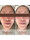 凪眠の写真/気になり始めた口横のぽにょ、フェイスラインのたるみをしっかり解決☆エイジングの悩みならラジオ波が◎