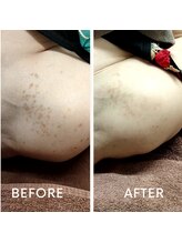 サロン ピューパ(Salon pupa)/シミケアBefore→After