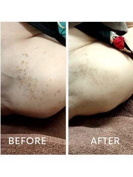 サロン ピューパ(Salon pupa)/シミケアBefore→After