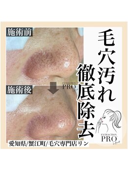 リン(Rin)/毛穴プロコース